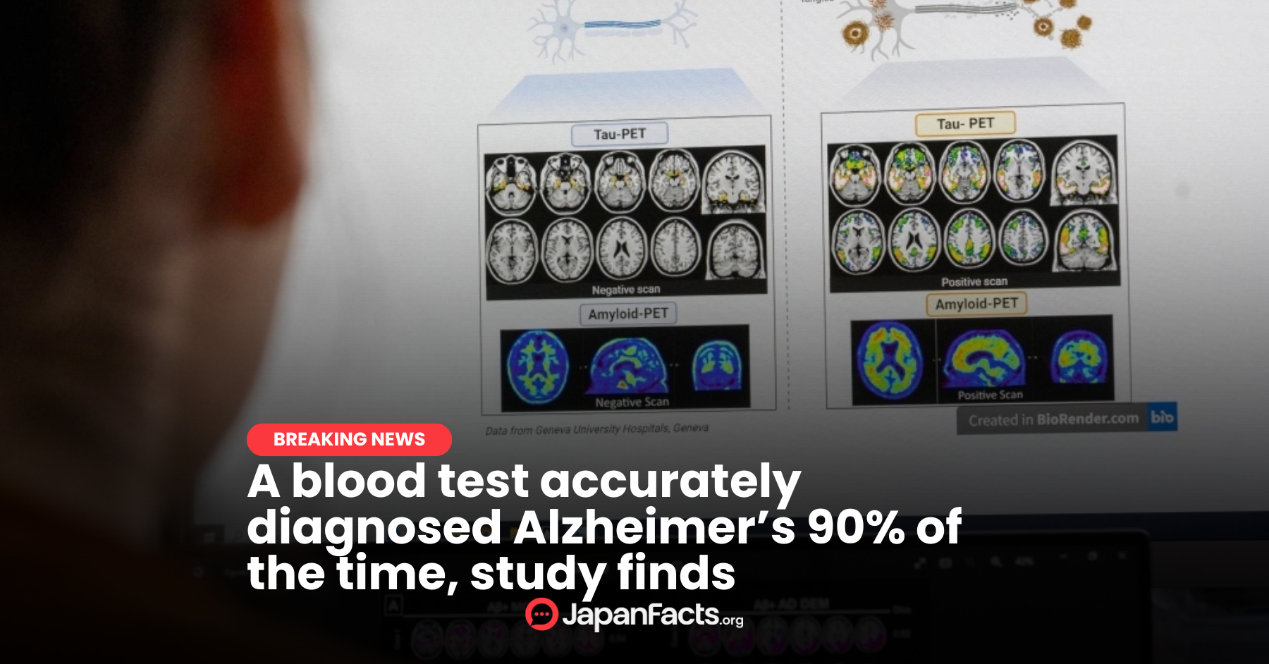 Revolutionary Blood Test for Alzheimer’s: More Accurate Than Ever